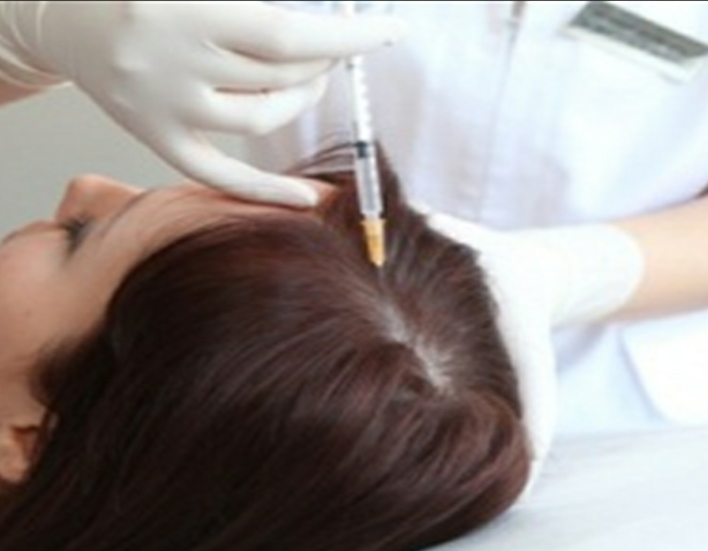 PRP Hair Therapy